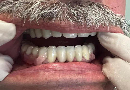 Purple Dance 3D Flexible Partial Denture and permanent crown resin-9